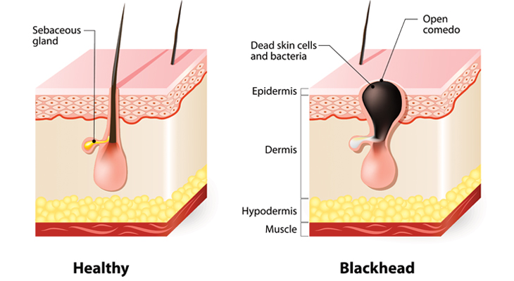 best blackhead remover