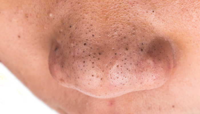 how to get rid of acne