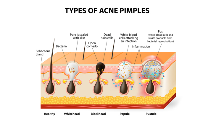 how to get rid of pimples