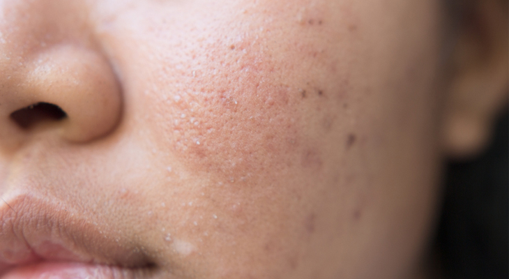 nodular acne