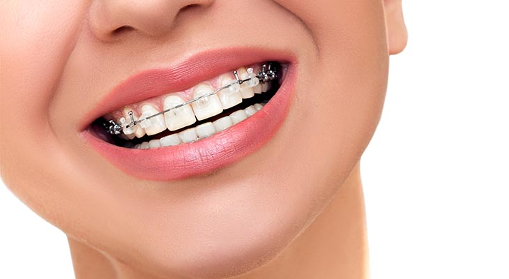 best toothpaste for braces