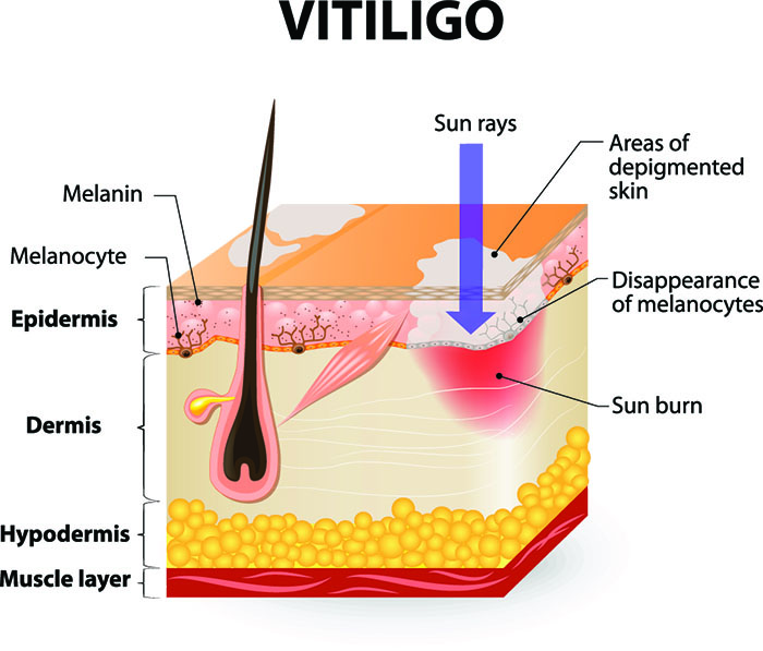 best sunscreen for vitiligo