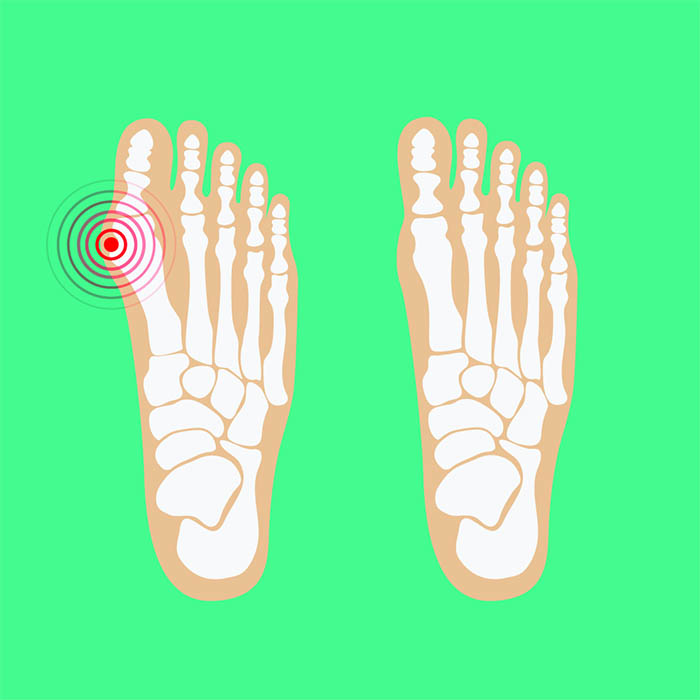 best bunion splints
