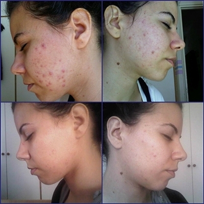 aloe vera on acne before and after