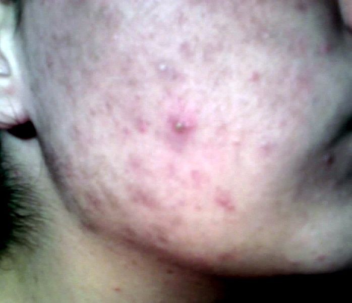 Laser Acne - Acne Skin Laser Acne - Acne Skin