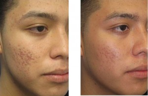 Laser Acne - Before & After Laser Acne - Before & After