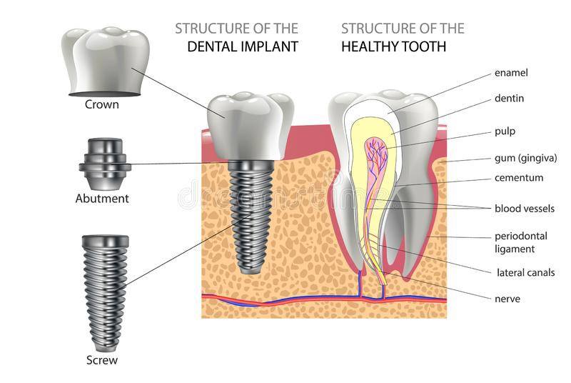 dental implants dental implants