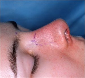 Rhinoplasty