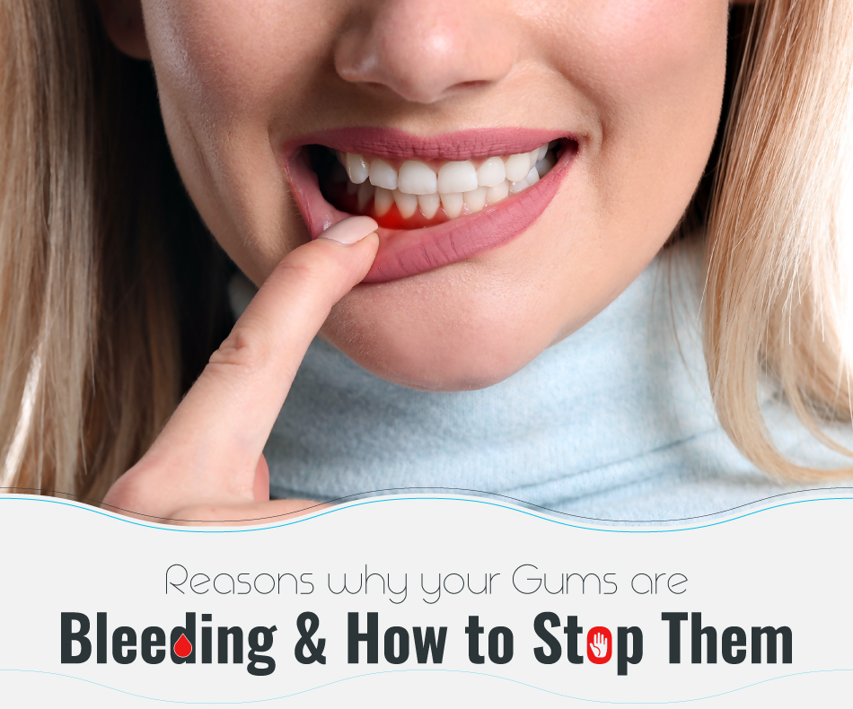 Reasons-Why-Your-Gums-Are-Bleeding-How-to-Stop-Them - featured image