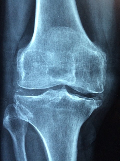 knee pain on xray
